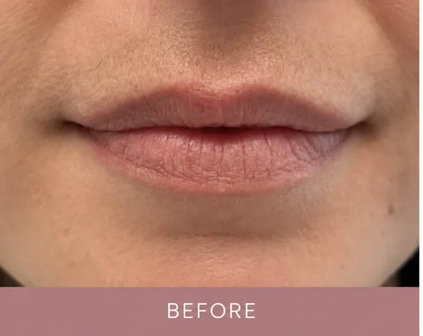 Lips before treatment