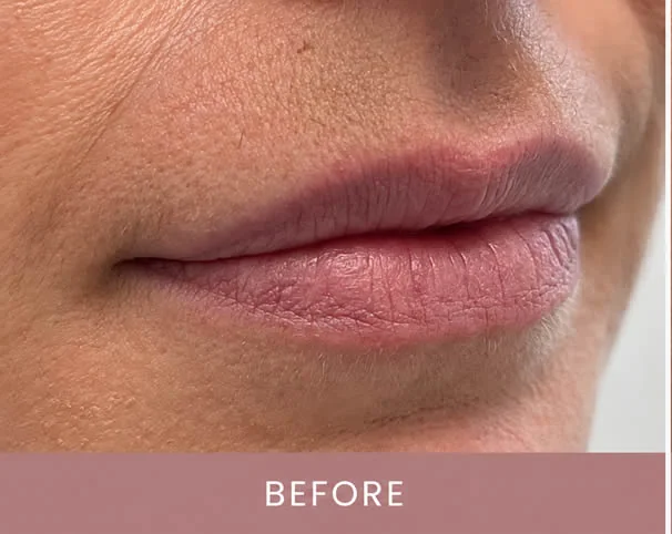 Lips before treatment