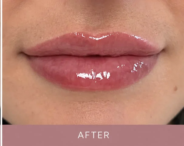 Lips after treatment