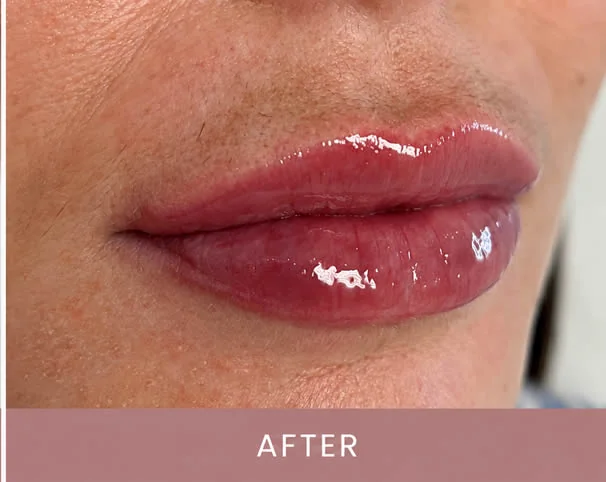 Lips after treatment