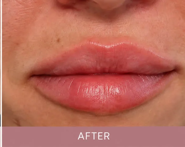 Lips after treatment