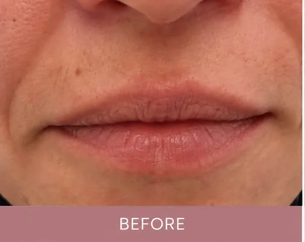 Lips before treatment