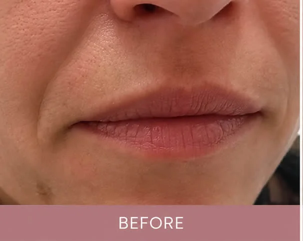 Lips before treatment